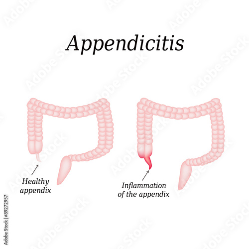 Appendicitis. Inflammation of the appendix. Colon. The