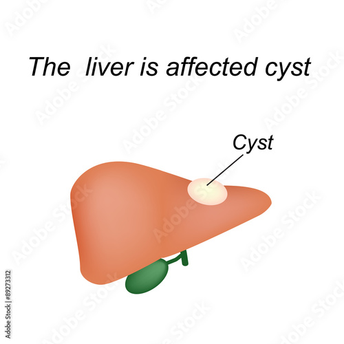 A cyst in the liver. The liver is affected cyst. Vector