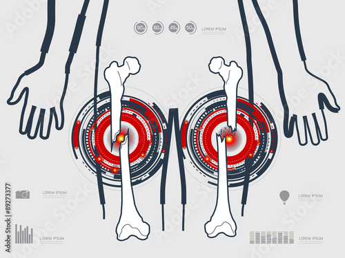 vector illustration of the leg fracture