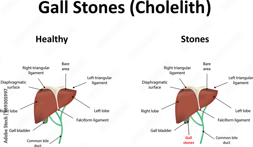 Obraz premium Gall Stones