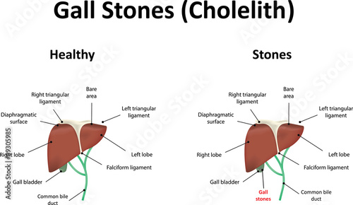 Gall Stones