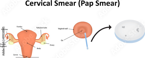 Cervical Smear