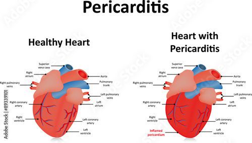 Pericarditis Illustration photo