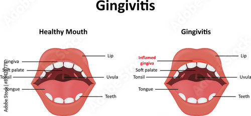 Gingivitis Illustration