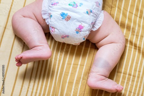Birthmark on Asian baby girl legs