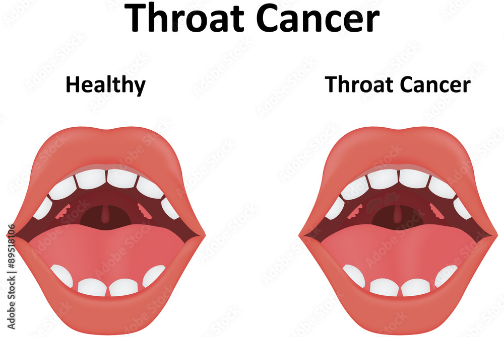 Fototapeta premium Throat Cancer Illustration