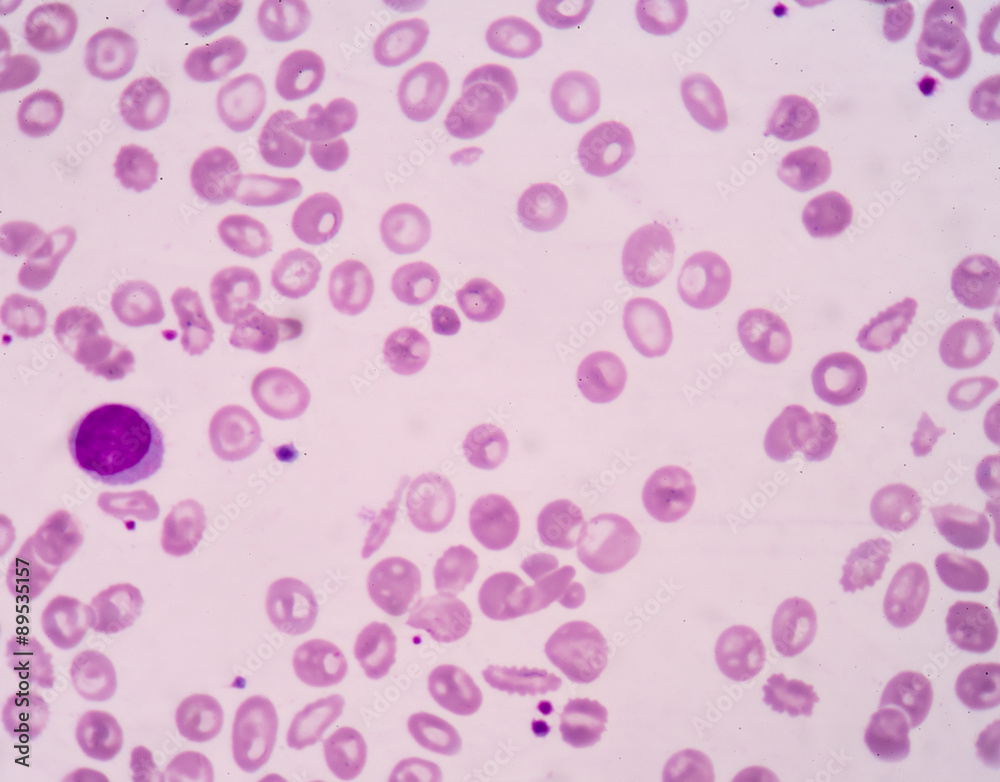 Blood picture patient Thalassemia.