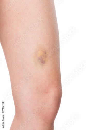 Woman nursing an injured bruised grazed knee