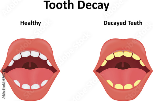 Tooth Decay