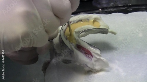 Place an old dentures making the plaster mold