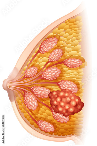 Breast cancer diagram in detail