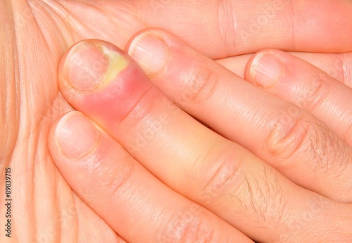 Hand or finger infection detail