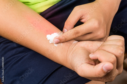 Bild auf Leinwand Baking soda being used to relieve itching from rashes.