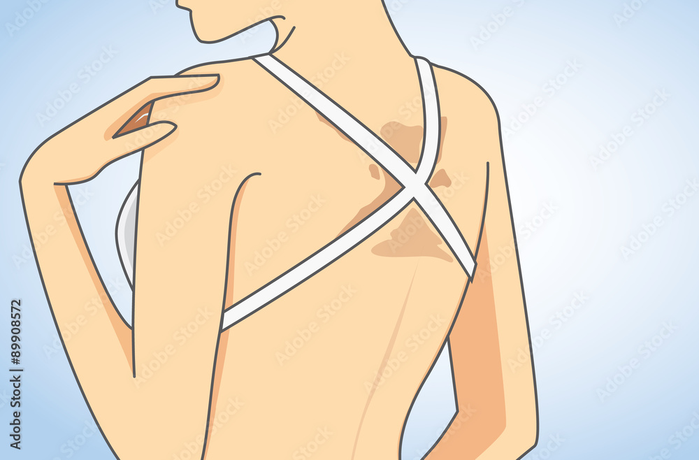 Fototapeta premium Woman wearing bikini has skin discoloration on back in close up illustration