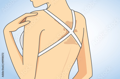 Woman wearing bikini has skin discoloration on back in close up illustration