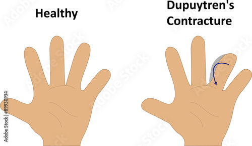 Dupuytren's Contracture Illustration   © joshya