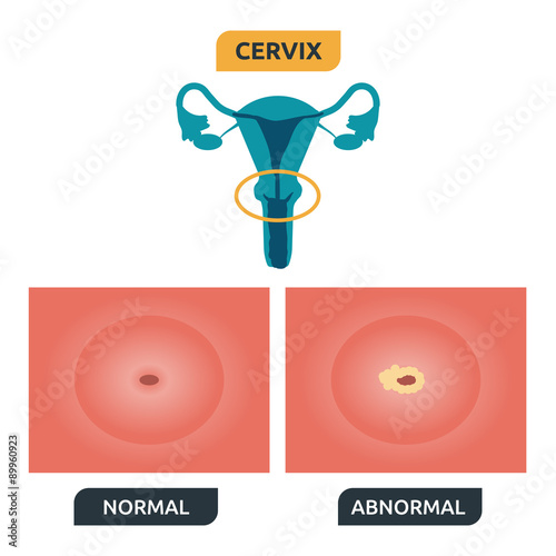 Cervix