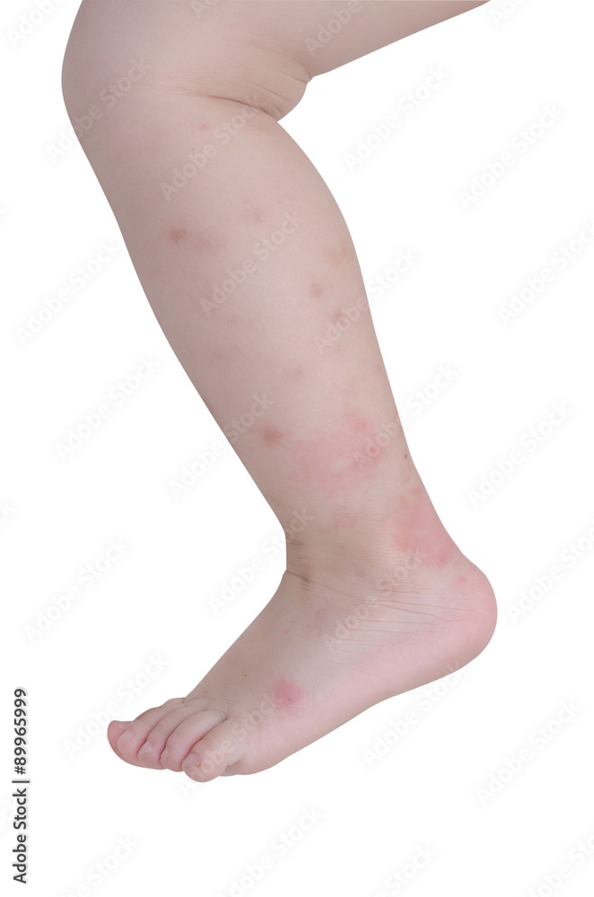 Mosquito bites sore on baby legs over white background Mosquito bites sore on baby legs over white background