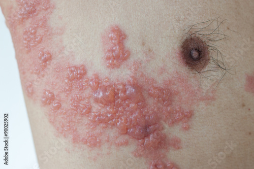 Herpes zoster photo