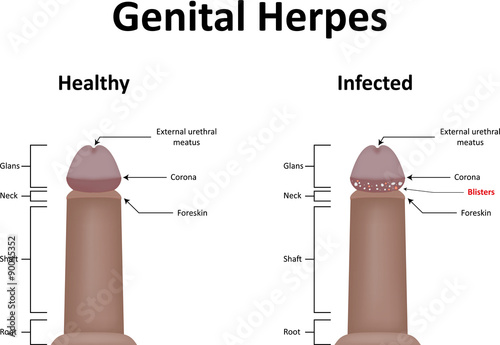 Fotobehang Genital Herpes Illustration