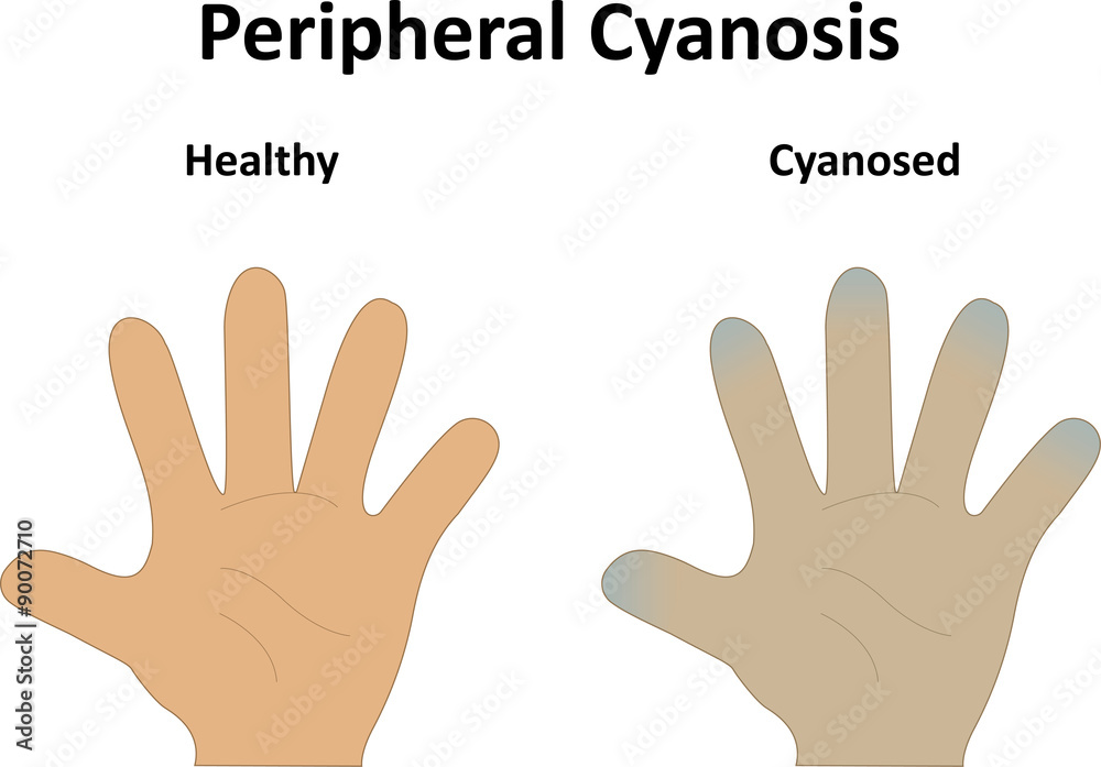 Peripheral Cyanosis Peripheral Cyanosis