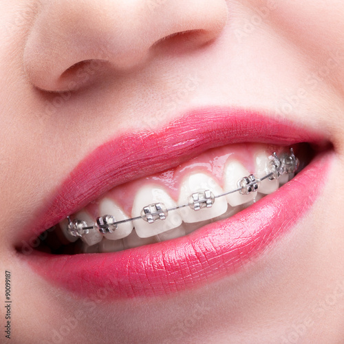 Closeup of woman open smiling mouth with brackets