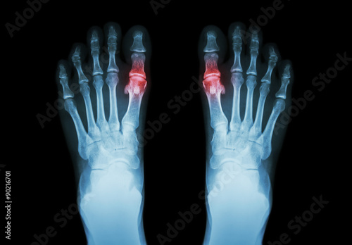 Gout , Rheumatoid arthritis ( Film x-ray both foot and arthritis at first metatarsophalangeal joint ) ( Medicine and Science background )