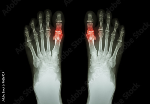 Gout , Rheumatoid arthritis ( Film x-ray both foot and arthritis at first metatarsophalangeal joint ) ( Medicine and Science background ) photo
