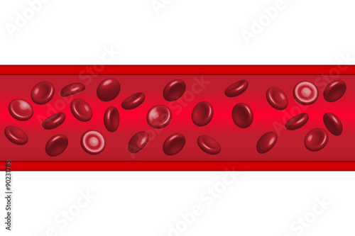 Red blood cells flowing in Atherosclerosis, illustration, vector