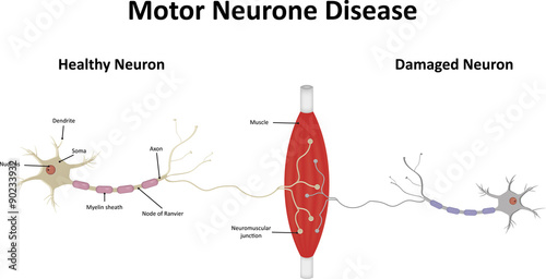 Motor Neurone Disease Illustration photo