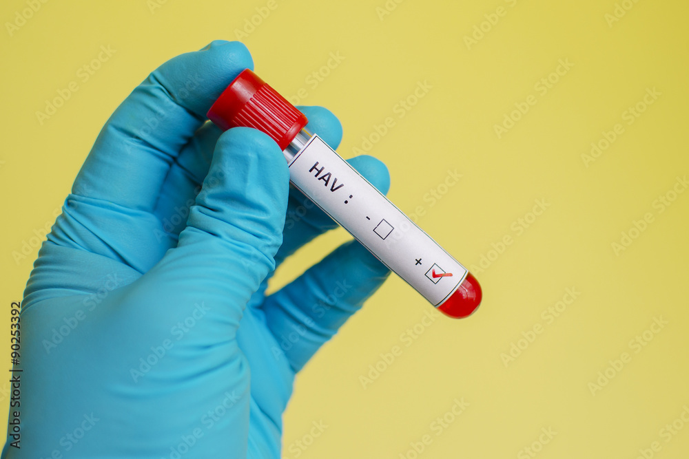 Fototapeta premium Hepatitis A virus (HAV) positive
