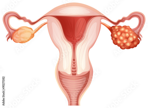 Ovarian cancer in woman