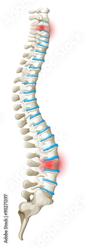 Spine back pain diagram