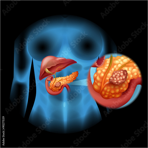 Pancreas cancer diagram in detail