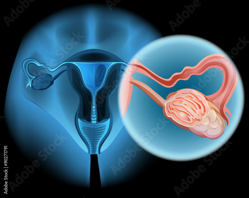 Ovarian cancer diagram in woman