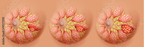 Breast cancer diagram in three stages