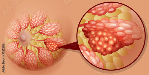 Breast cancer diagram in detail