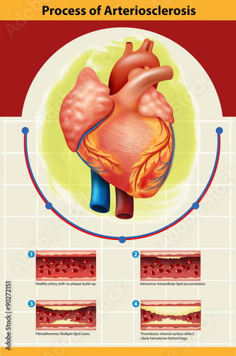 Poster of Arteriosclerosis process