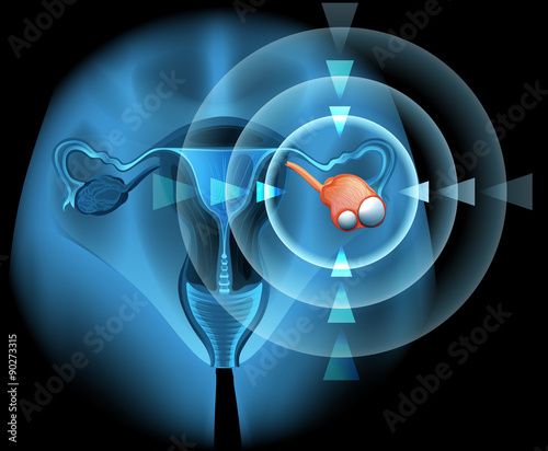 Ovarian diagram with focus