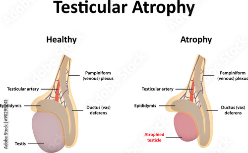 Testicular Atrophy Illustration