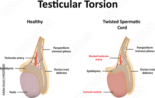 Testicular Torsion Illustration photo