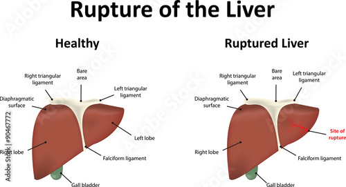 Ruptured Liver