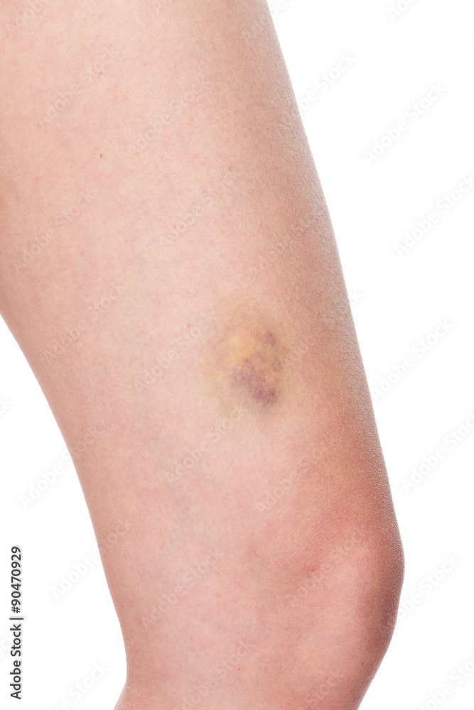 Woman with sore leg Woman with sore leg