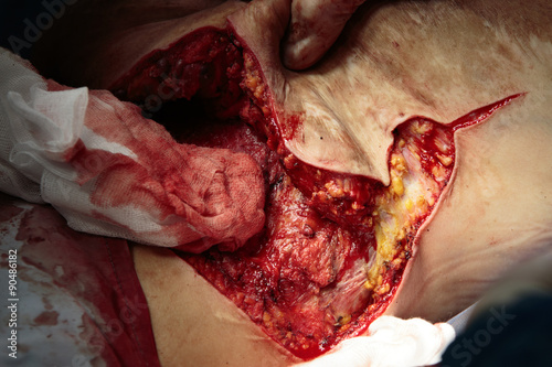 Wide access to the wound