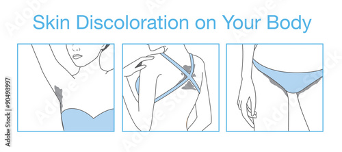 Discoloration of the skin on body part after suntan or outdoor activities