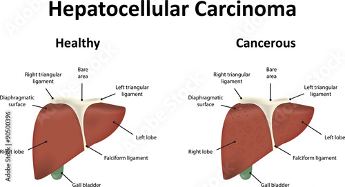 Hepatocellular Carcinoma Illustration