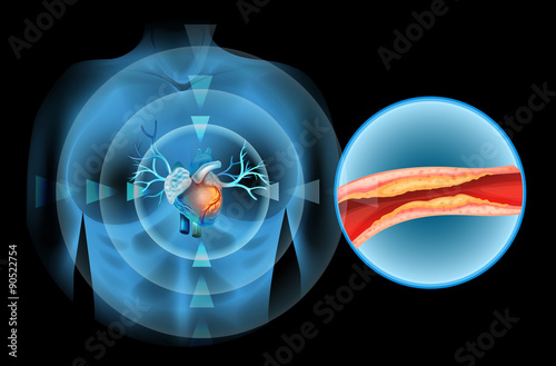 Cholesteral clocked in human heart