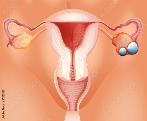 Overian cancer diagram in detail
