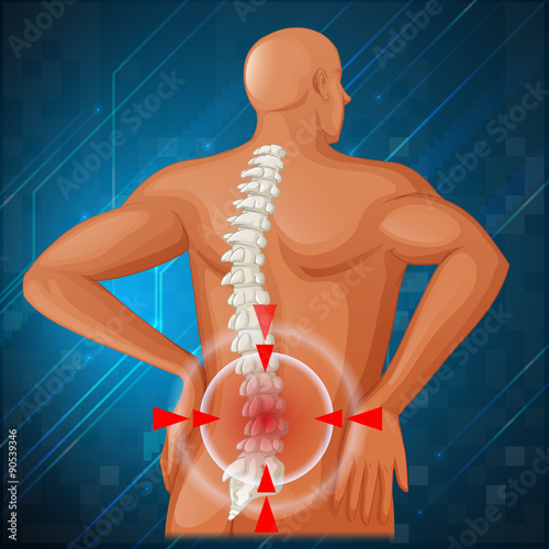 Spine diagram showing back pain