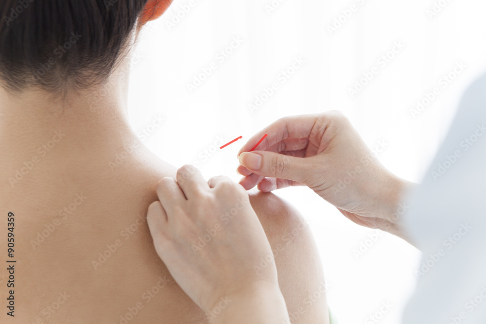 Acupuncturist is treating a woman's shoulder Acupuncturist is treating a woman's shoulder